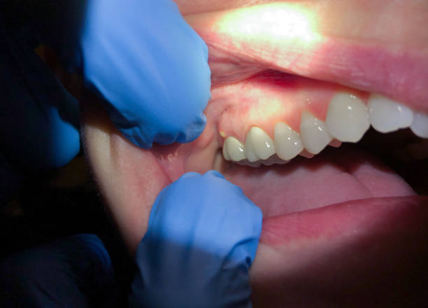 Best Emergency Dentist for Knocked-Out Tooth in Redfield, SD